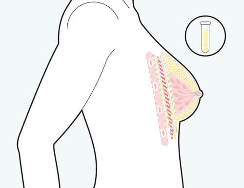 Brustvergrößerung mit Eigenfett, nachher, Plastische Chirurgie Berlin, AesthetiCum, Dr. Ahrens, Dr. Fritzsch 