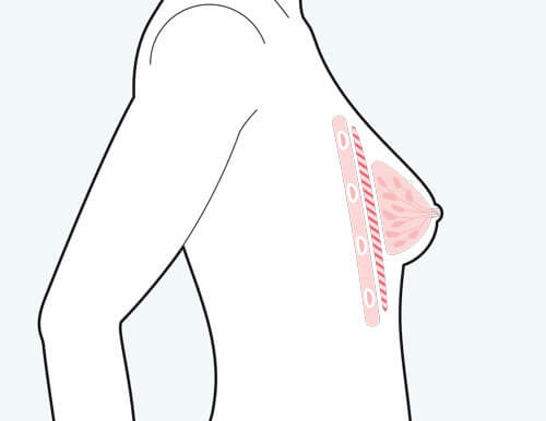 Brustvergrößerung mit Eigenfett, vorher, Plastische Chirurgie Berlin, AesthetiCum, Dr. Ahrens, Dr. Fritzsch 