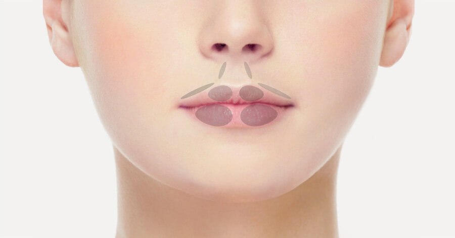 Einzeichnung Lippen aufspritzen, Plastische Chirurgie Berlin, AesthetiCum, Dr. Ahrens, Dr. Fritzsch 